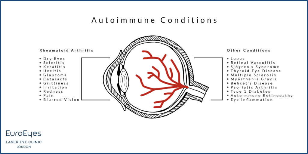 What Illness Can An Eye Test Detect? - EuroEyes
