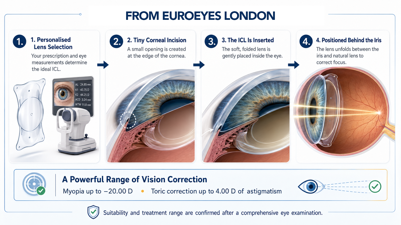 how-implantable-contact-lenses-work-diagram